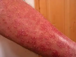 Psoriasis Vulgaris