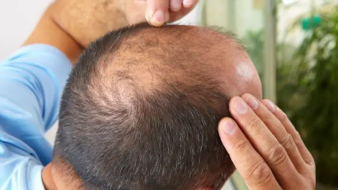 Haarausfall Haarausfall