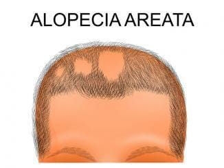 Kreisrunden Haarausfall: Alopecia areata