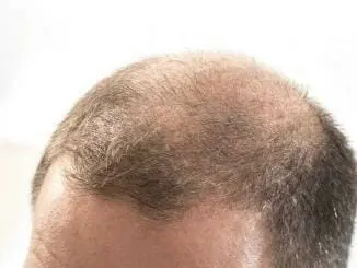 Erblich bedingter Haarausfall bei Männern