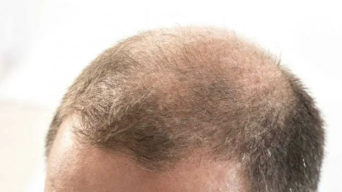 Erblich bedingter Haarausfall bei Männern