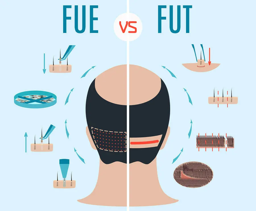 FUE-Methode FUT-Methode