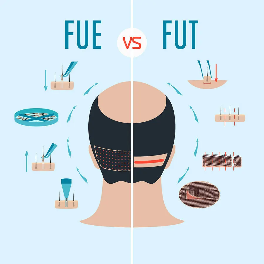 FUE Methode VS FUT Methode