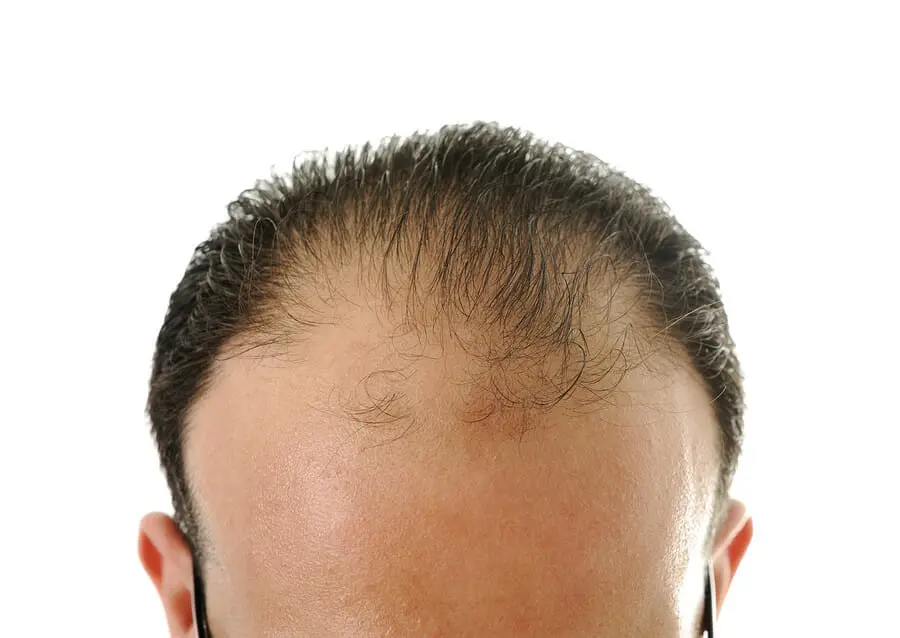 Wie schnell wachsen Haare, wenn der Haarzyklus gestört ist?