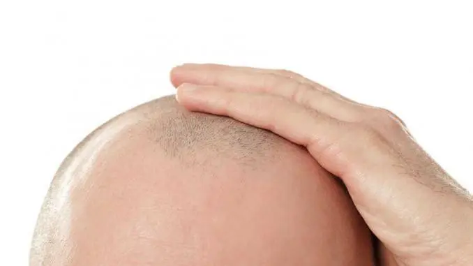 androgene Alopezie