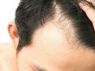Haartransplantation Geheimratsecken ohne Rasur