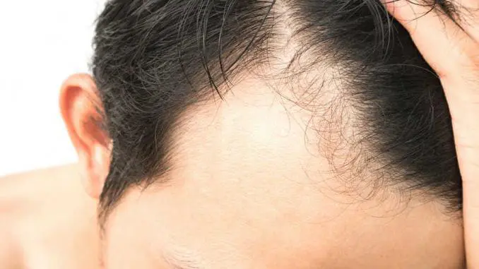 Haartransplantation Geheimratsecken ohne Rasur