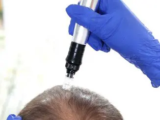 Microneedling gegen Haarausfall