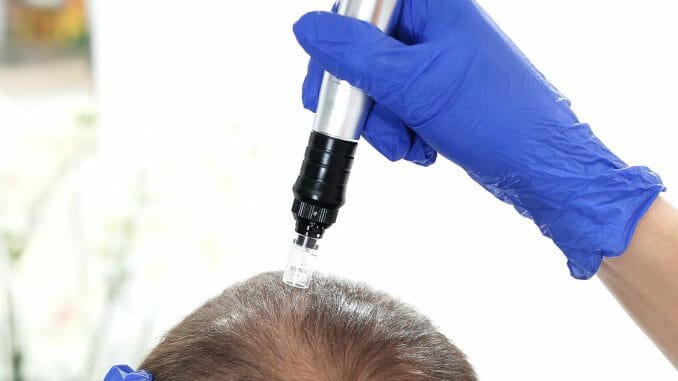 Microneedling gegen Haarausfall Microneedling gegen Haarausfall