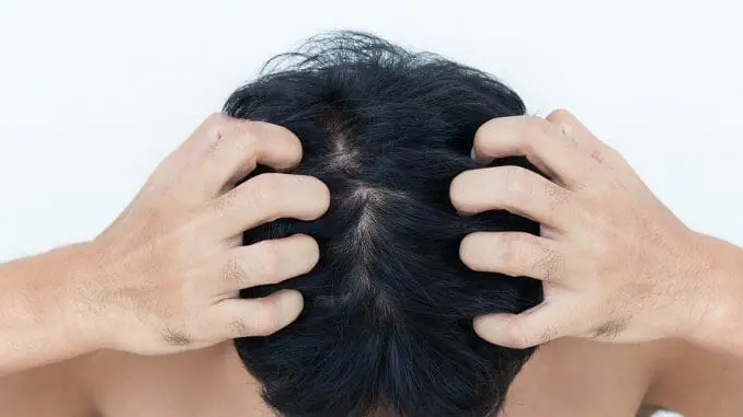 Trockene Kopfhaut und Haarausfall Trockene Kopfhaut und Haarausfall