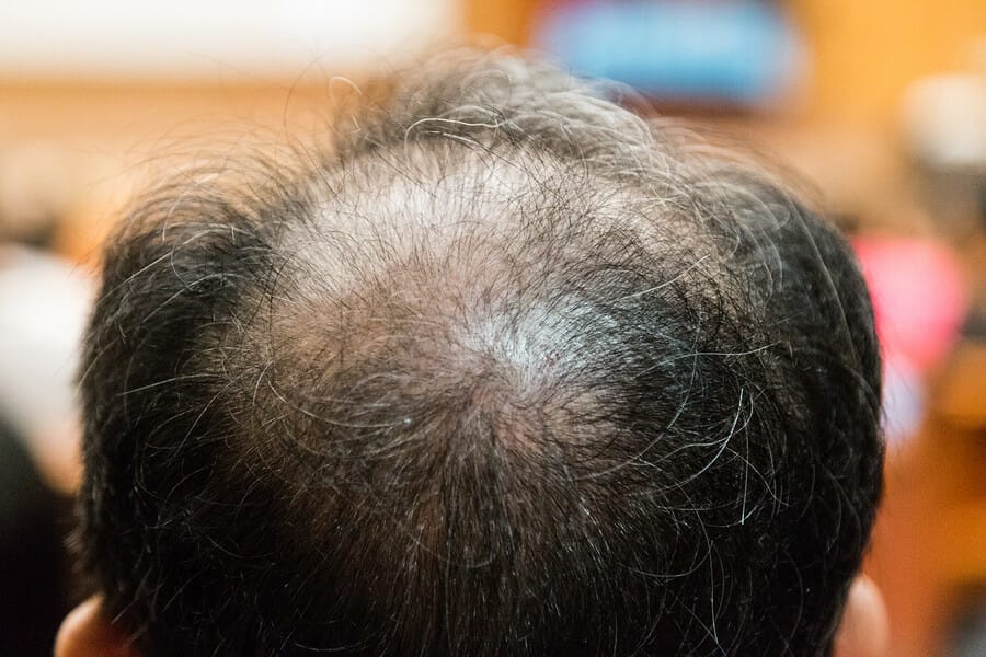 Tut beim bewegen haare weh kopfhaut Kopfhaut tut