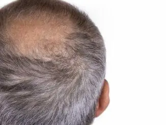 Alopecia universalis