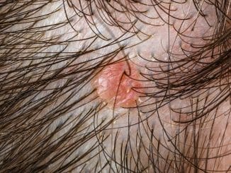 Pickel nach Haartransplantation