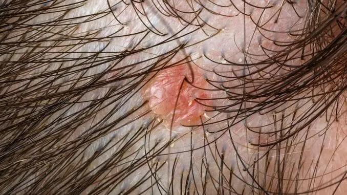 Pickel nach Haartransplantation Pickel nach Haartransplantation