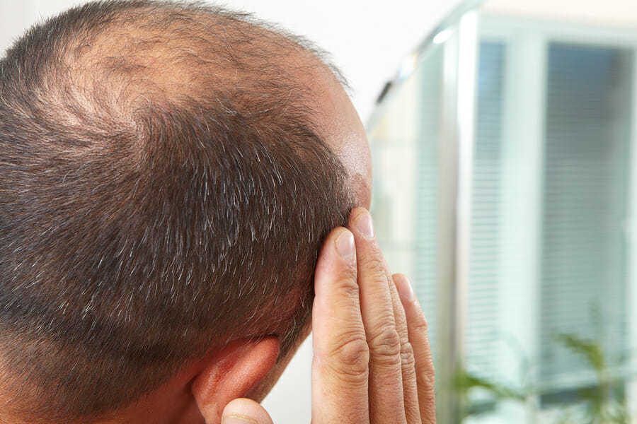 Erblich bedingter Haarausfall