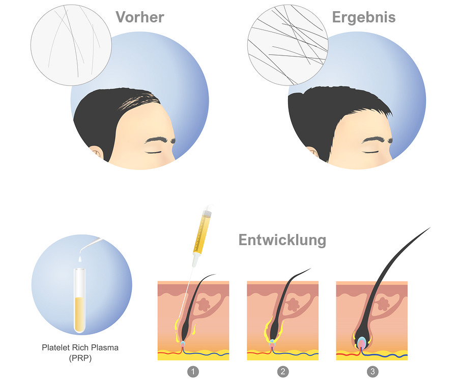 Vampir Lifting vorher nachher Vampir Lifting vorher nachher