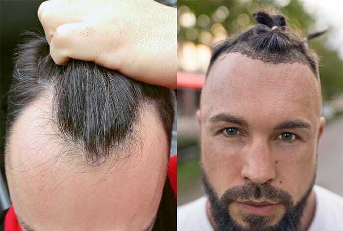 Haare geheimratsecken lange mann Wie Männer