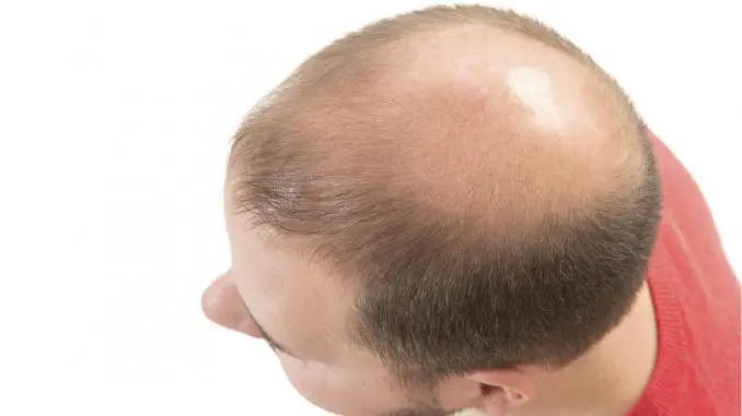 Haartransplantation mit 20 Haartransplantation mit 20