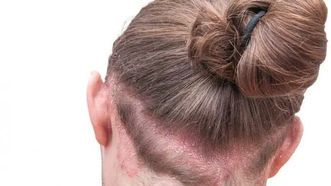 Kopfhaut Pilzinfektion und Haarausfall
