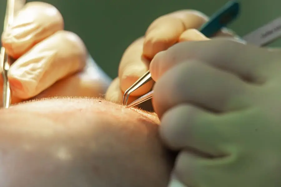 Haartransplantation Behandlung