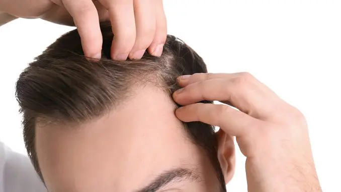 Krusten nach der Haartransplantation Krusten nach der Haartransplantation