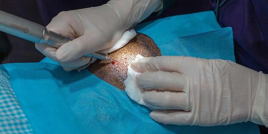 Haartransplantation