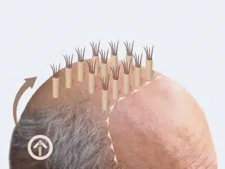 Haartransplantation