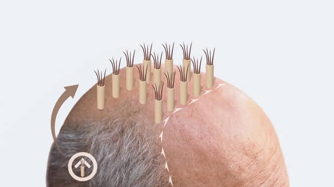 Haartransplantation