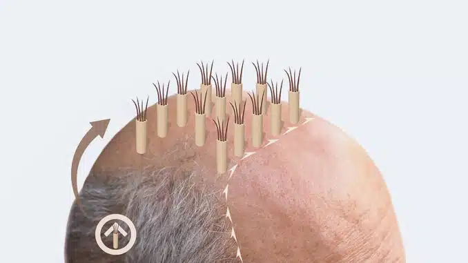 Haartransplantation Haartransplantation