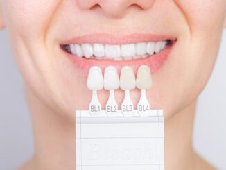 Veneers für Zähne