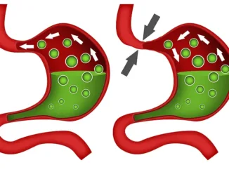 Fundoplicatio