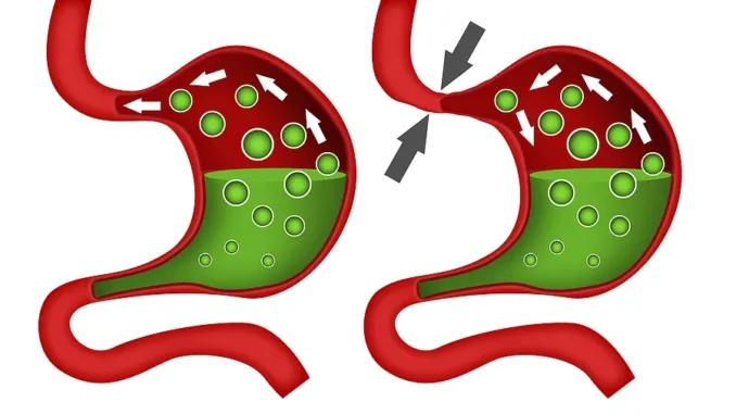 Fundoplicatio